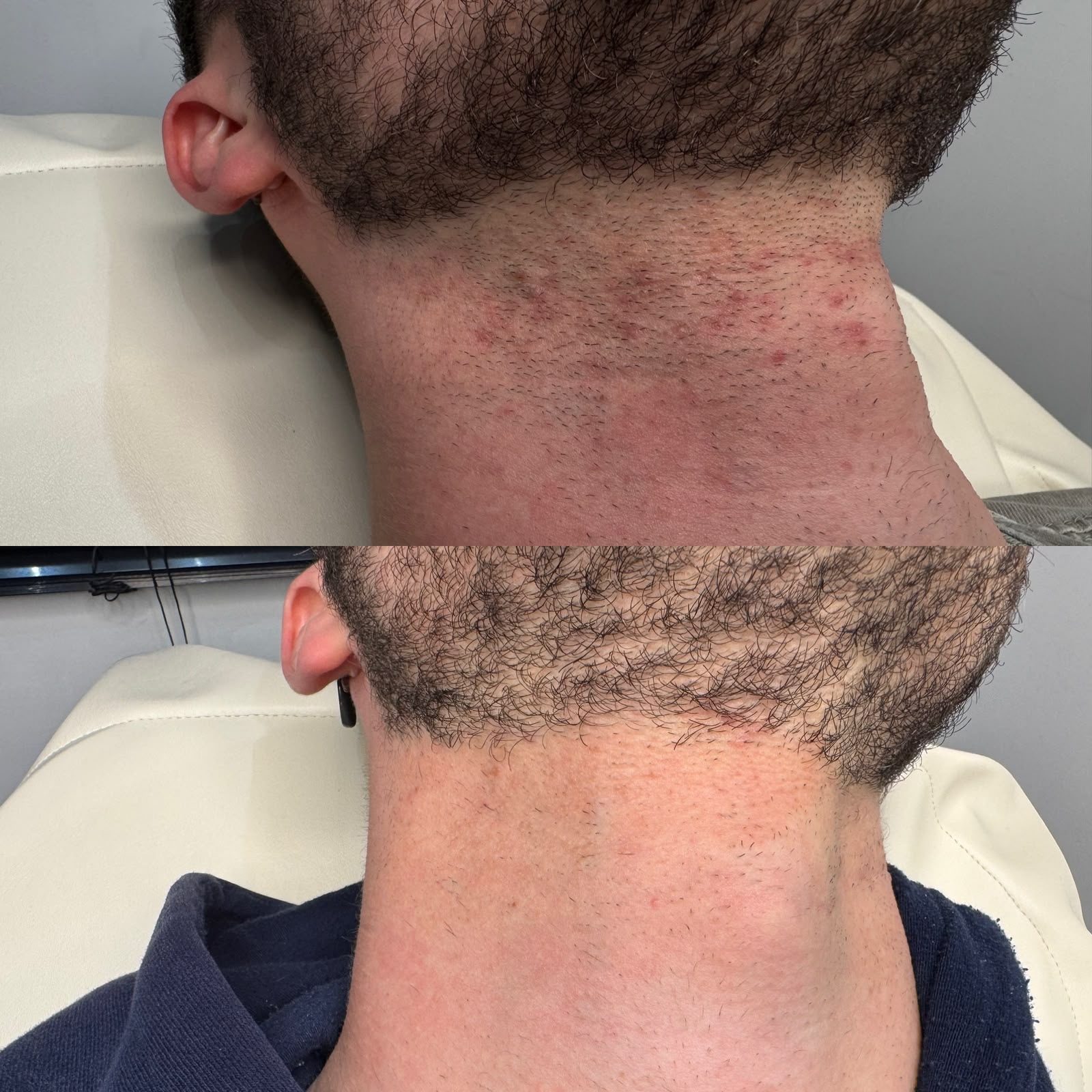 Laser hair removal result 1