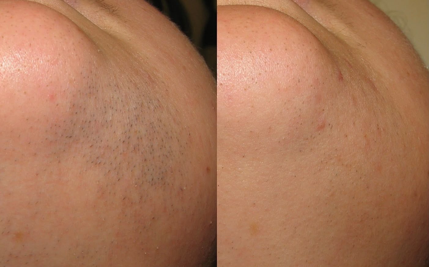 Laser hair removal result 2
