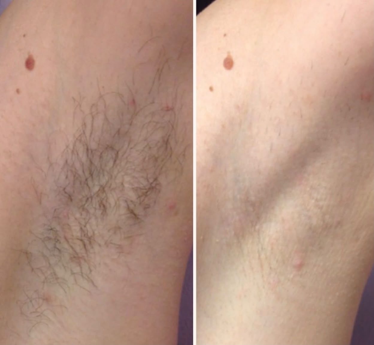 Laser hair removal result 3