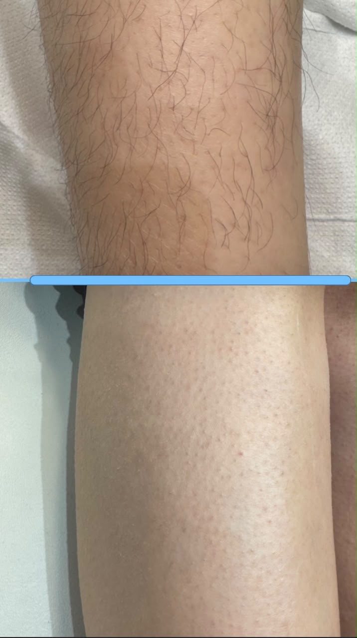 Laser hair removal result 4
