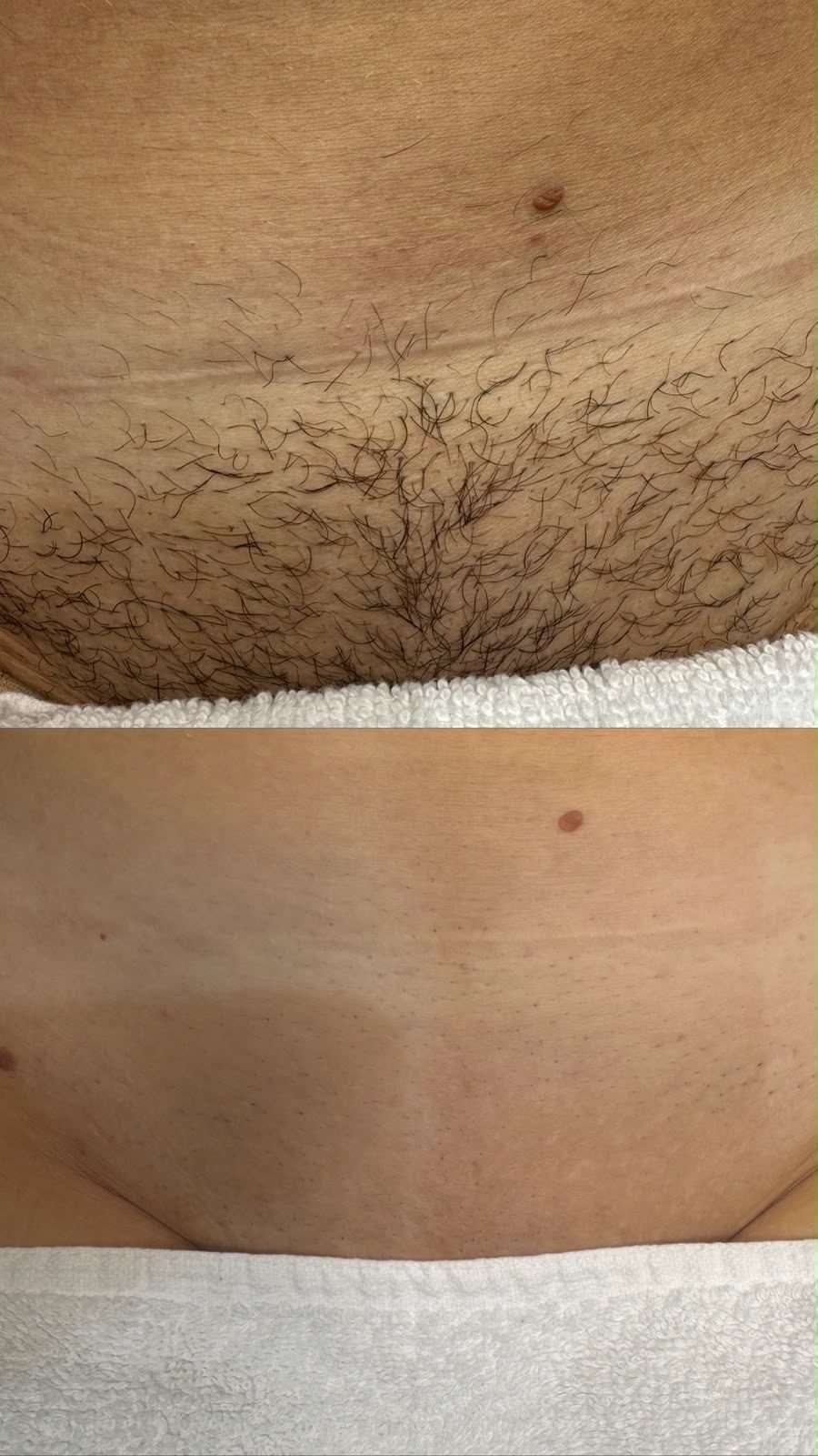 Laser hair removal result 5