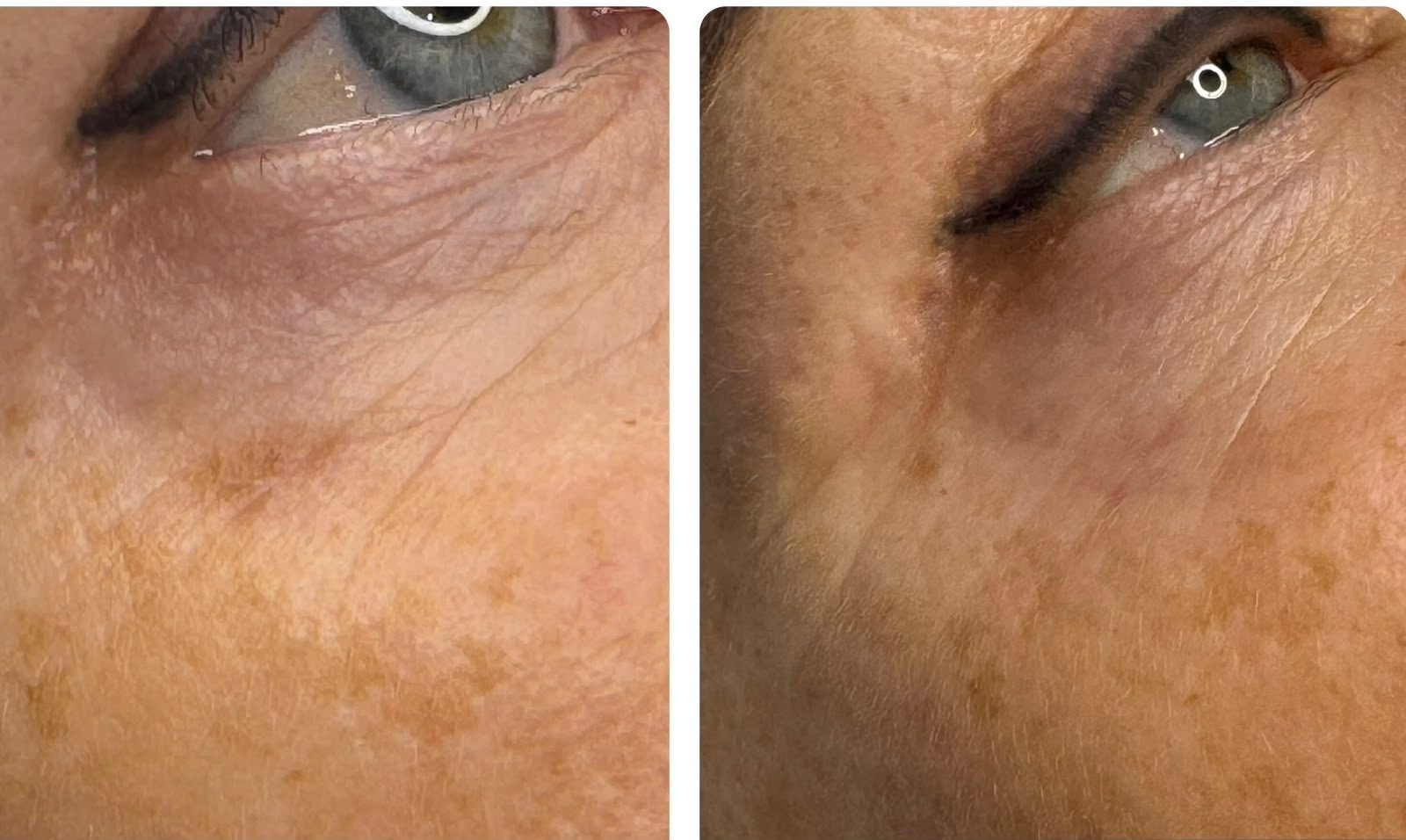 Pigmentation removal result 1