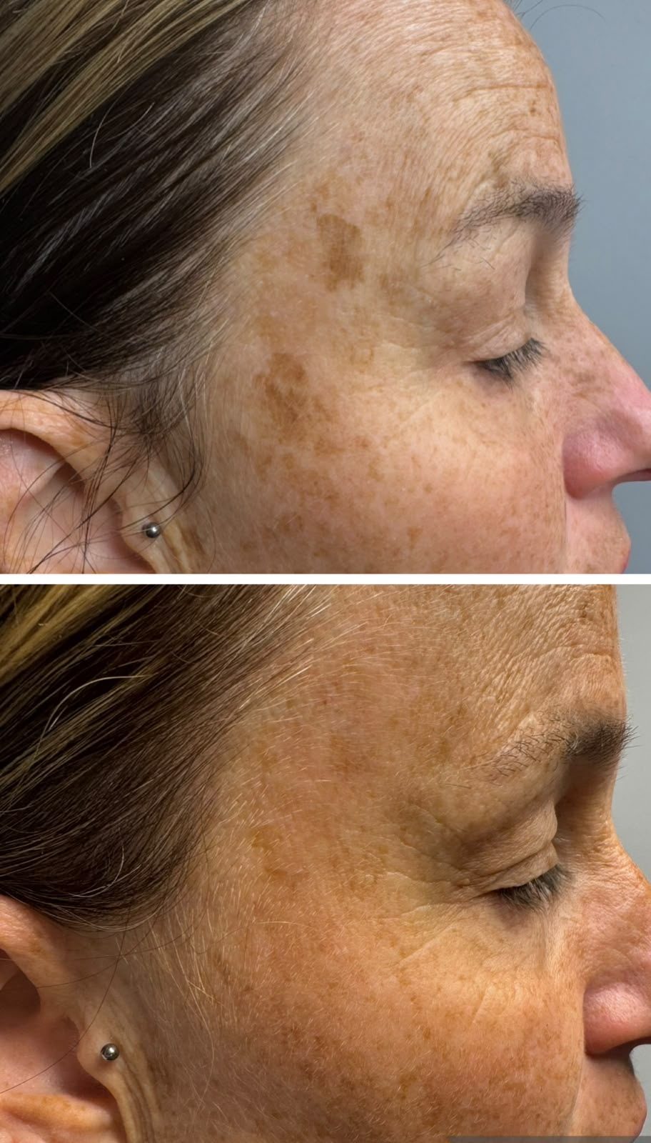 Pigmentation removal result 2