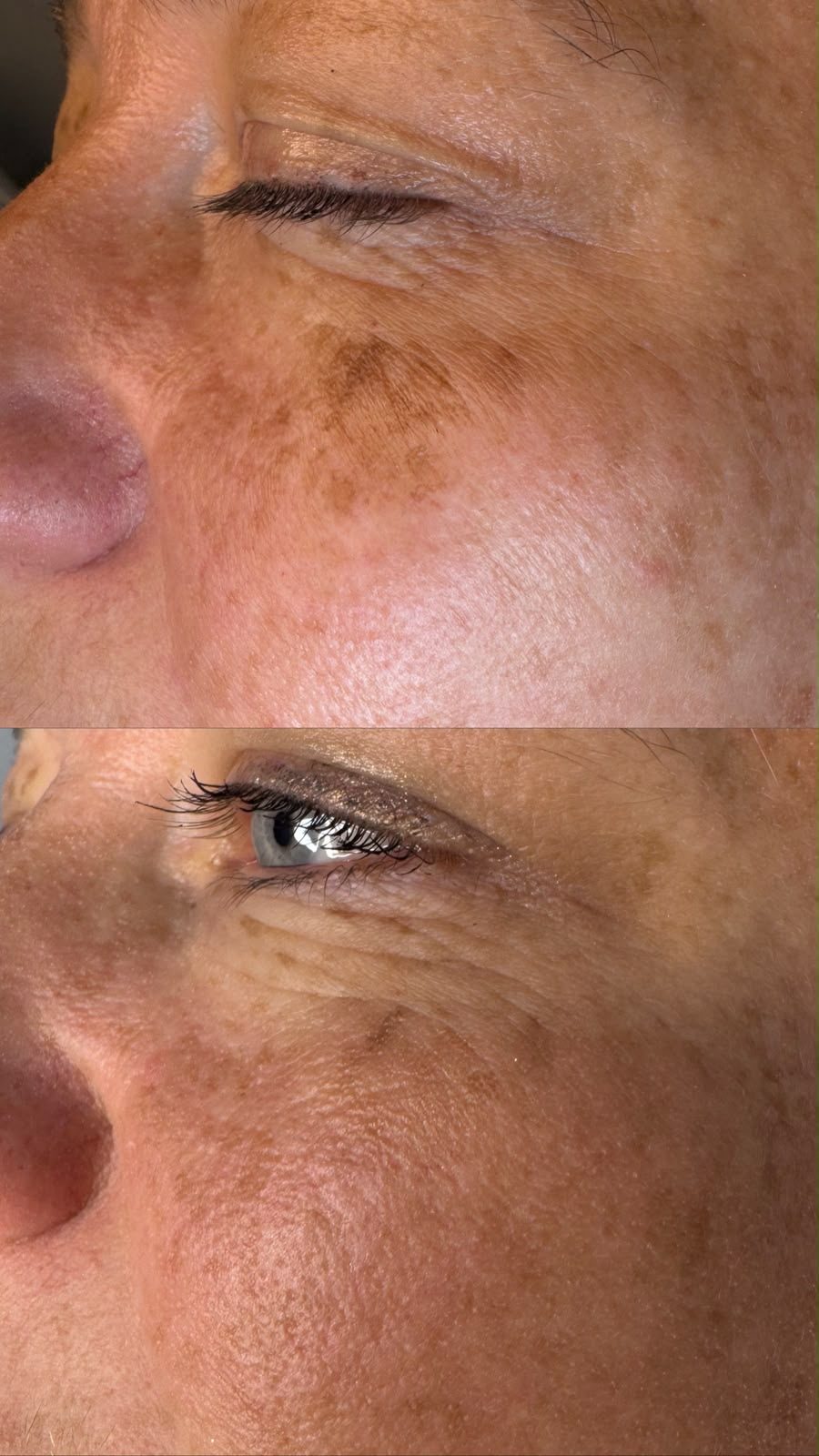 Pigmentation removal result 3