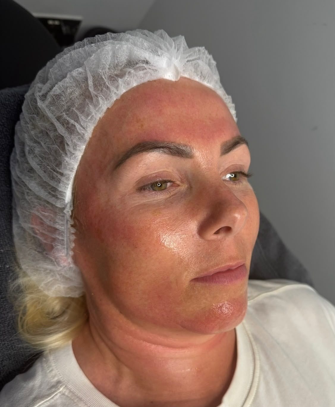 Skin rejuvenation treatment photo 6