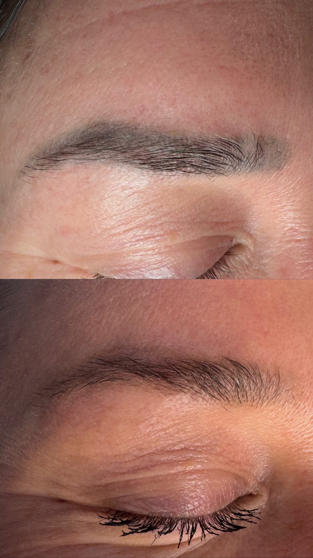 SPMU brow removal result 1