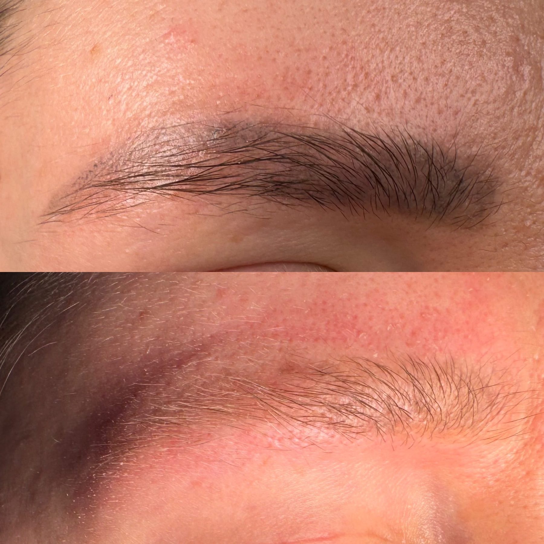SPMU brow removal result 2