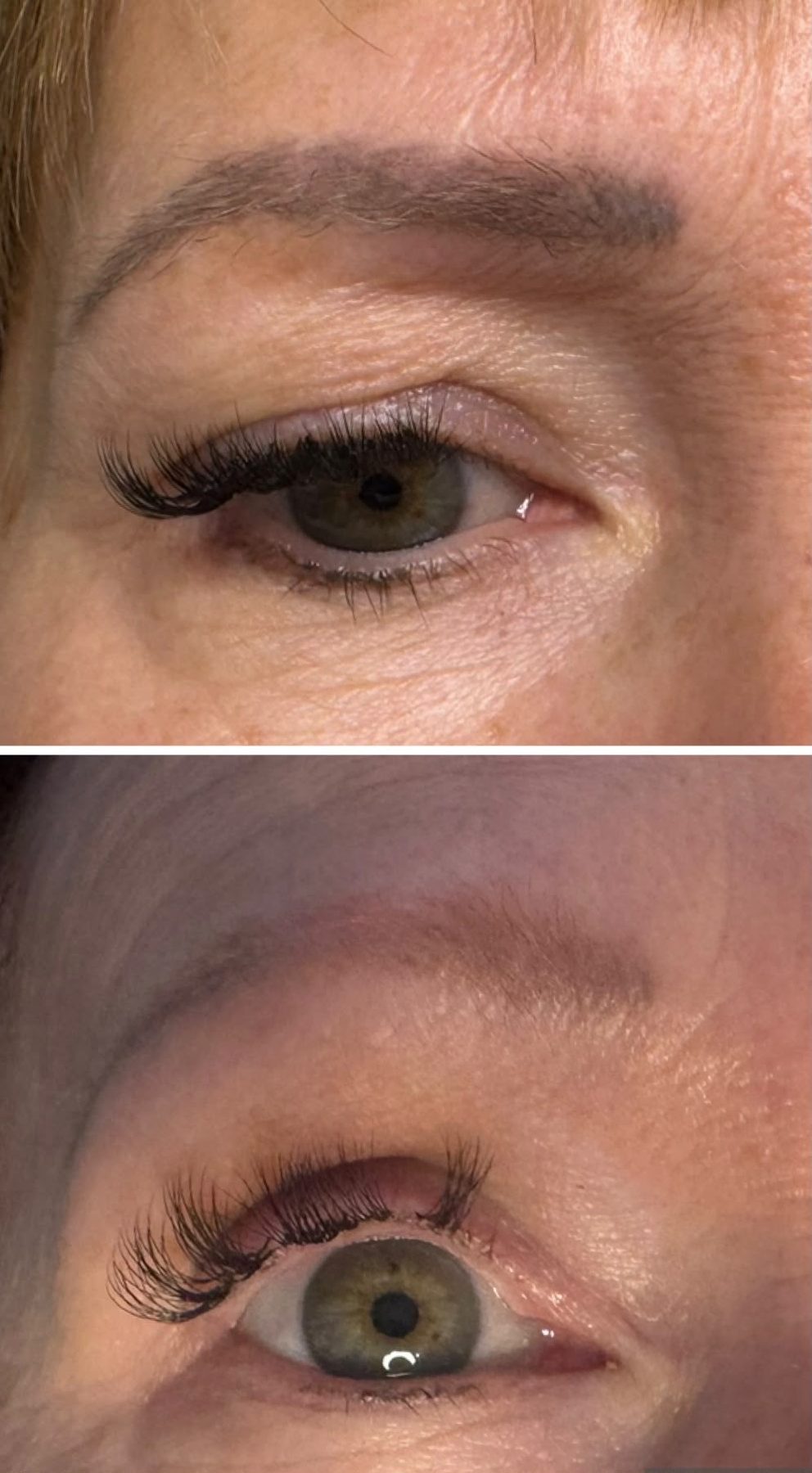 SPMU brow removal result 3