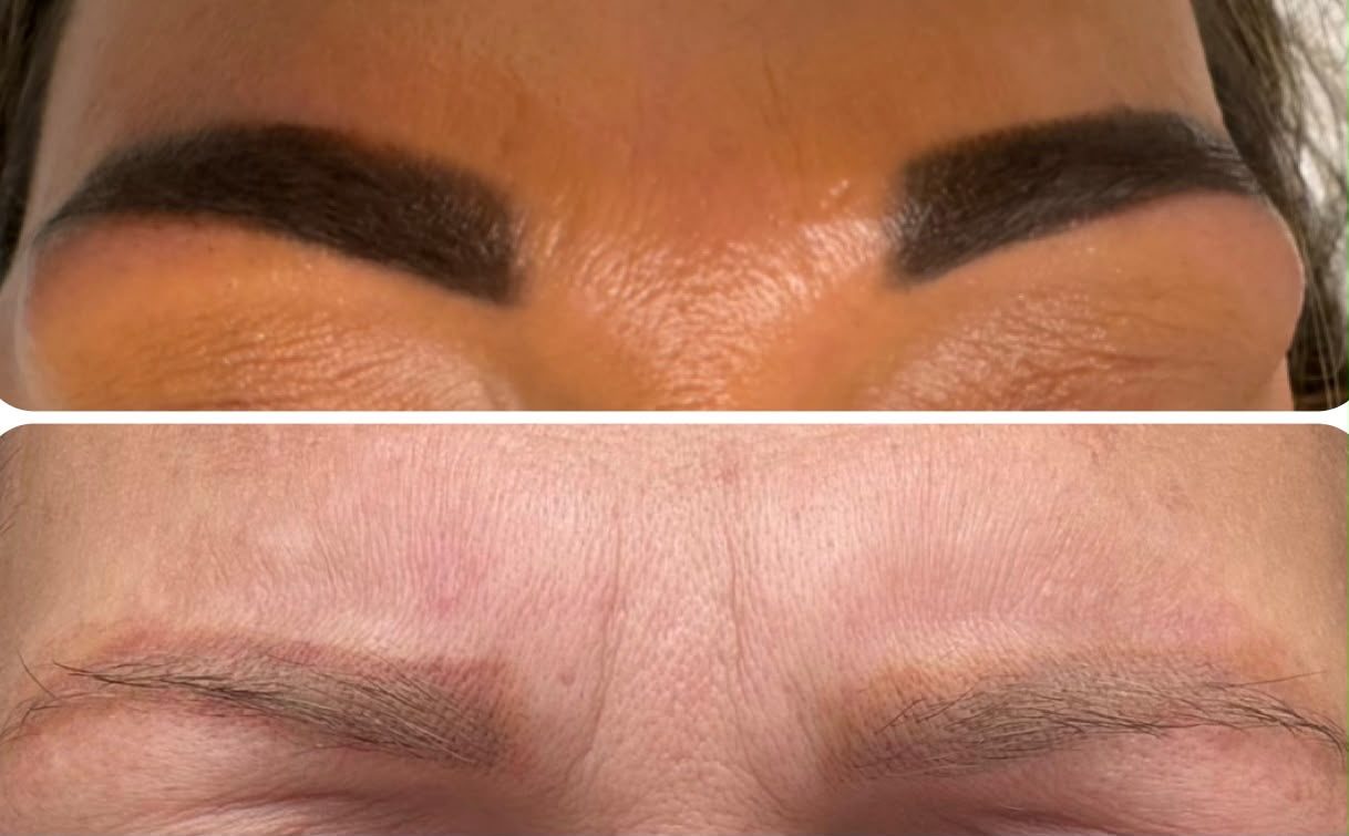 SPMU brow removal result 4
