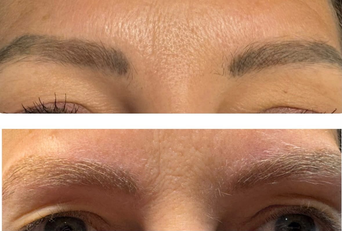 SPMU brow removal result 5