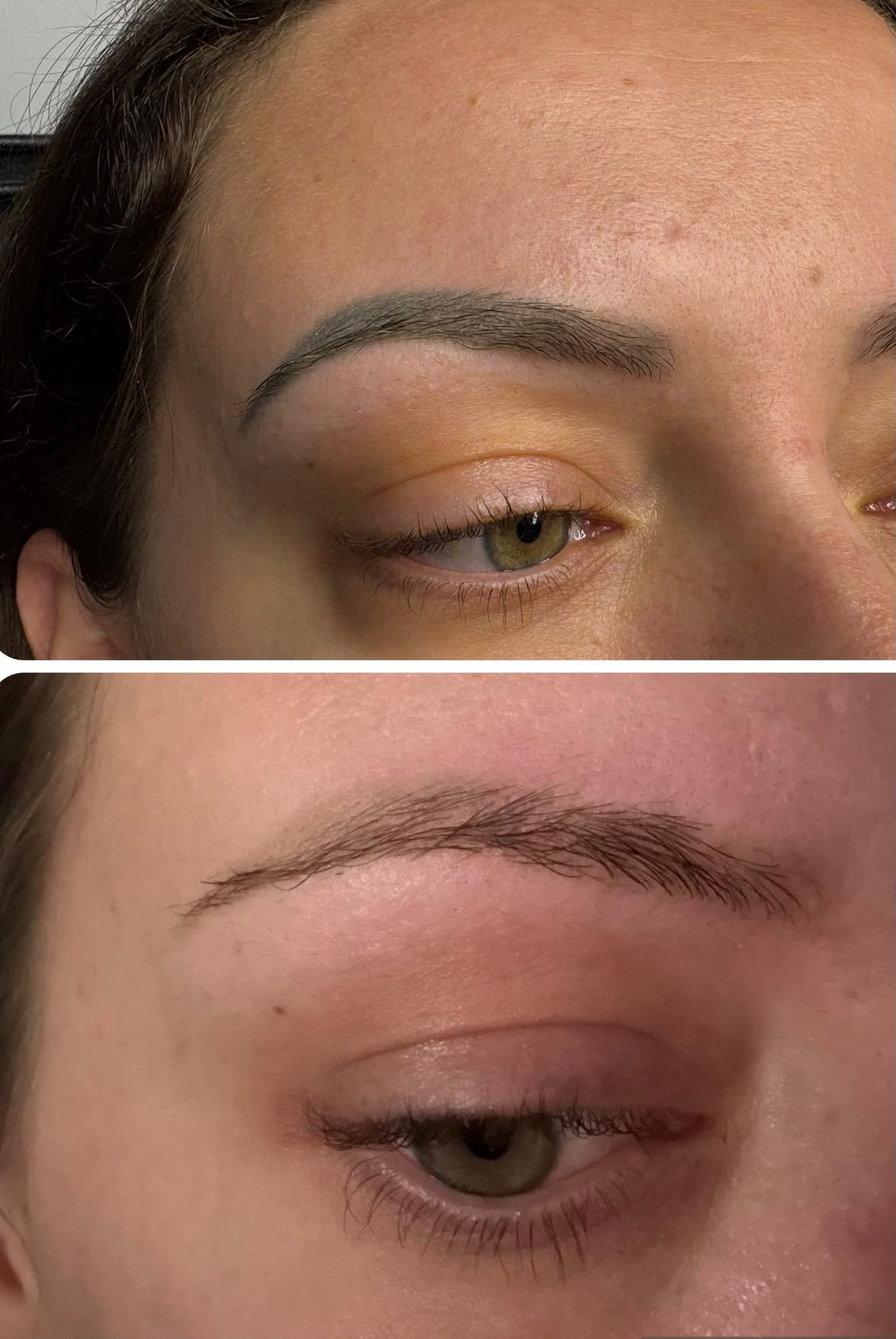 SPMU brow removal result 6