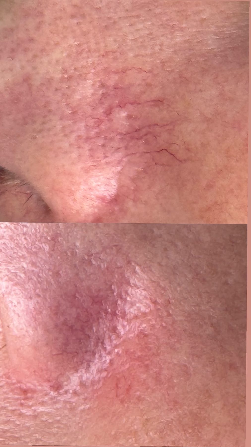 Thread vein removal result 1