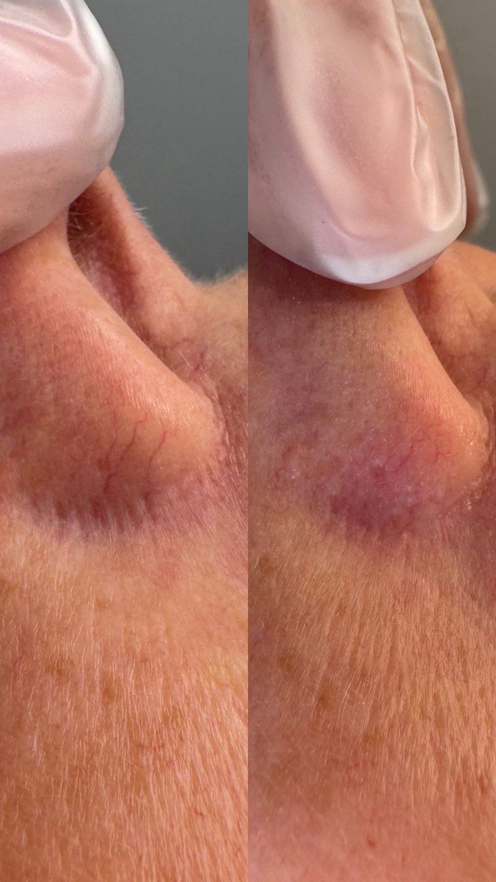 Thread vein removal result 2