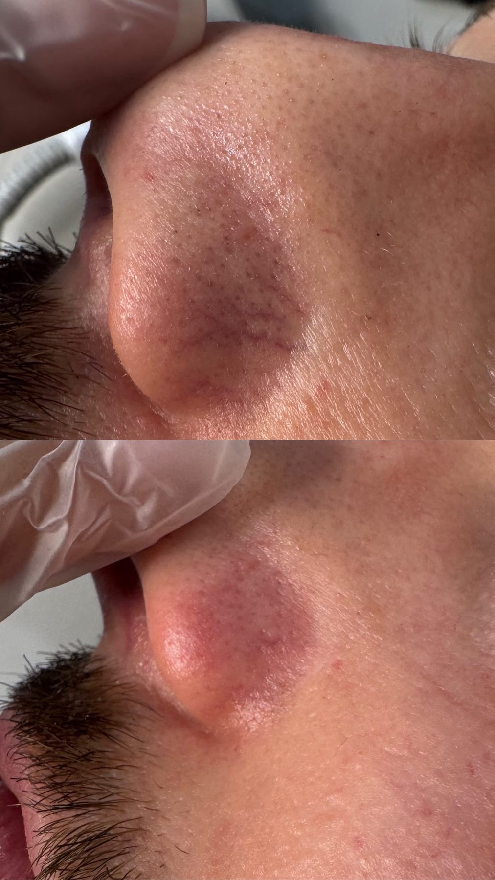 Thread vein removal result 3